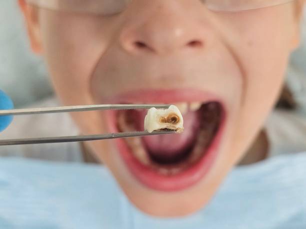 Best Emergency Dental Care for Abscessed Tooth in Landis, NC